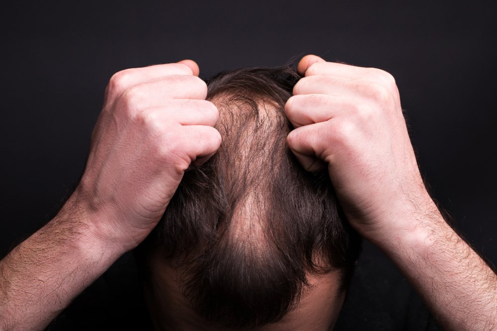 ¿Cuáles son las causas de caída de pelo en los hombres